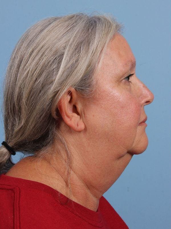 Facelift Patient Photo - Case 15692 - before view-2