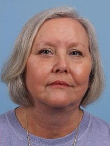 Facelift - Case 15692 - After