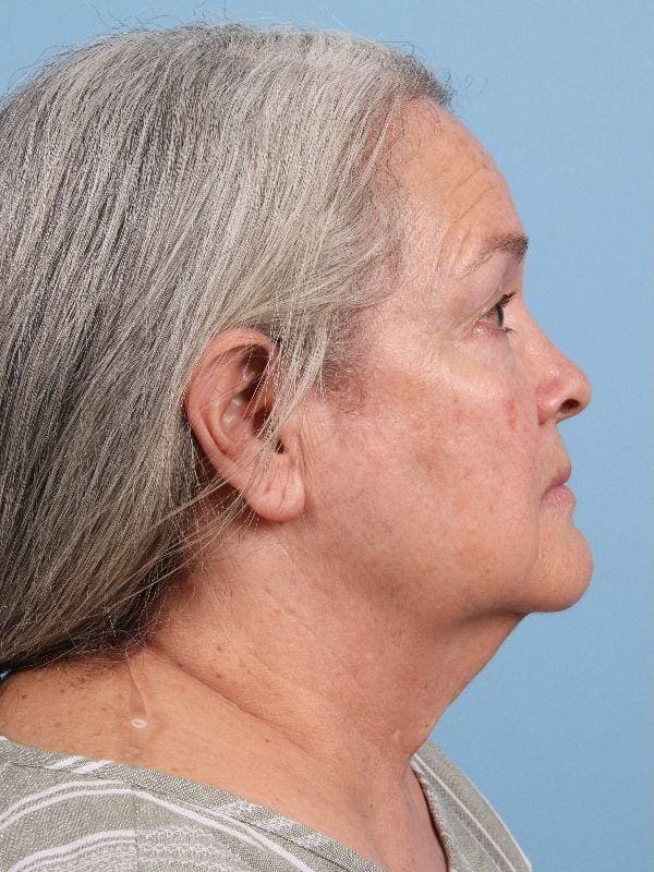 Facelift Patient Photo - Case 15715 - before view-2