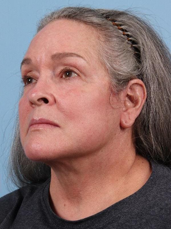 Facelift Patient Photo - Case 15715 - after view-3