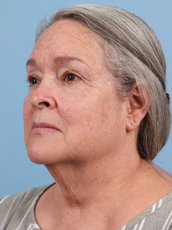 Facelift Patient Photo - Case 15715 - before view-3