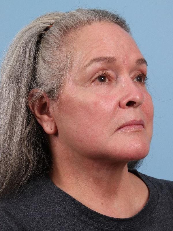 Facelift Patient Photo - Case 15715 - after view-4