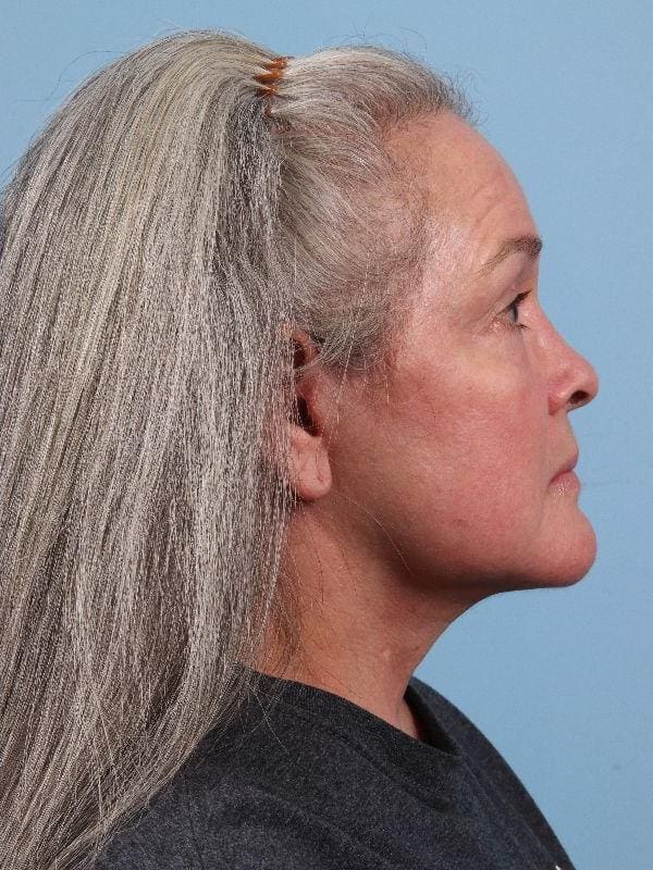 Facelift Patient Photo - Case 15715 - after view-2