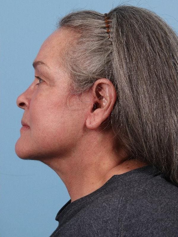 Facelift Patient Photo - Case 15715 - after view-1