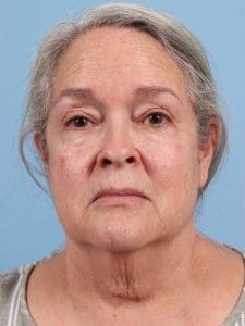 Facelift - Case 15715 - Before