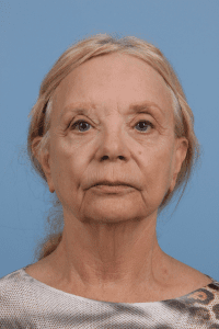 Facelift - Case 15727 - Before