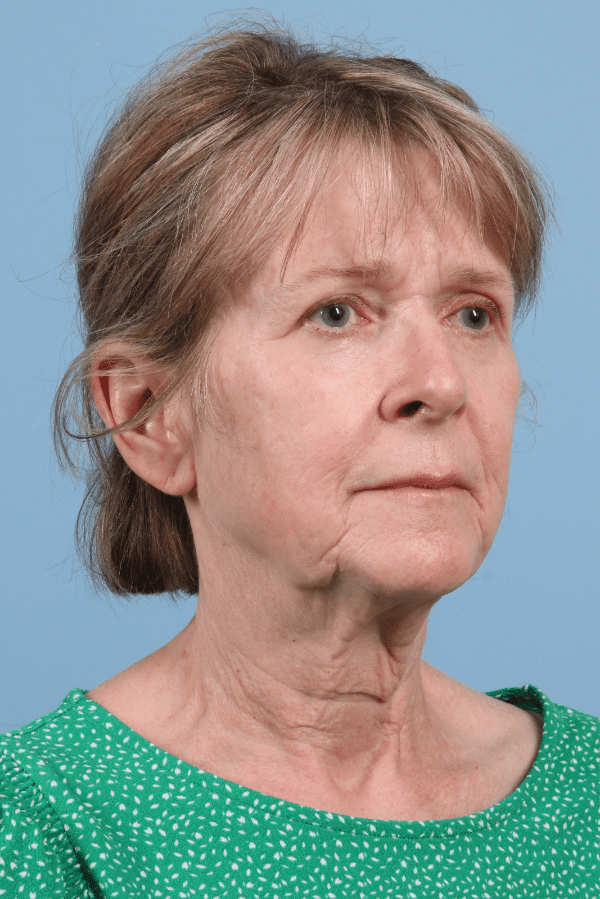 Facelift Patient Photo - Case 15738 - before view-4