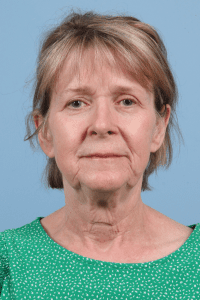 Facelift - Case 15738 - Before