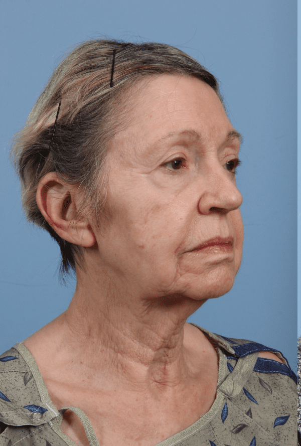 Facelift Patient Photo - Case 15751 - before view-4