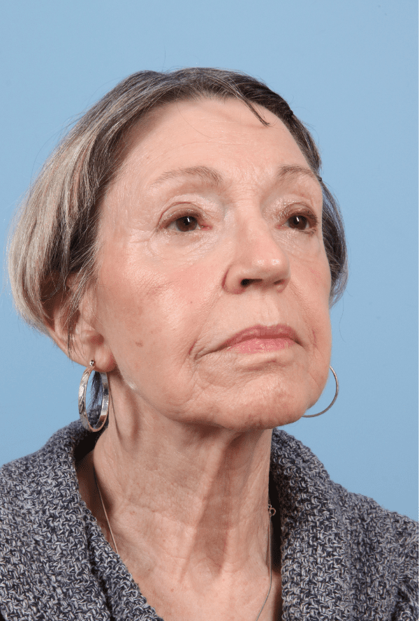 Facelift Patient Photo - Case 15751 - after view-4