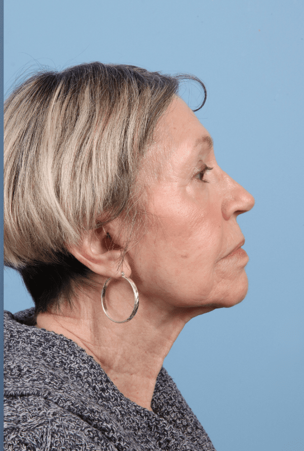 Facelift Patient Photo - Case 15751 - after view-2