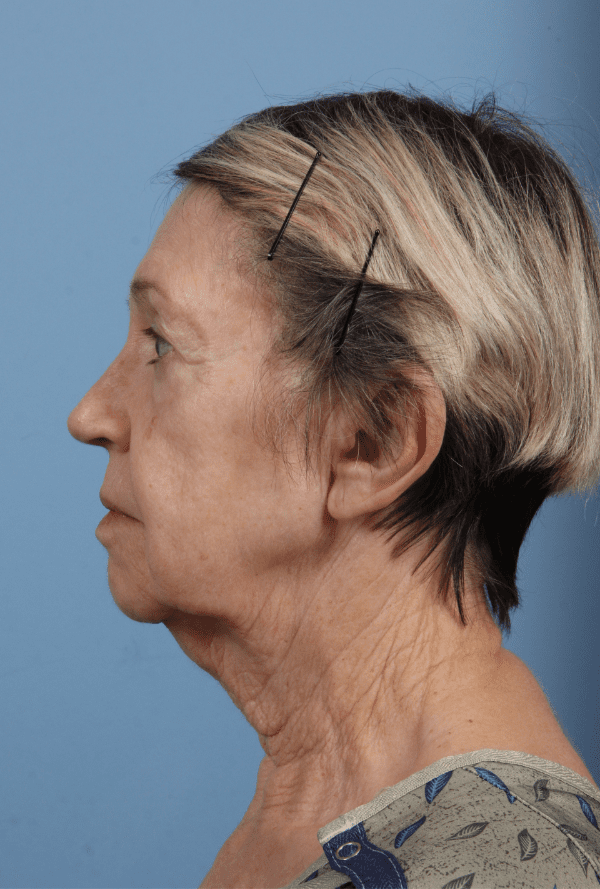 Facelift Patient Photo - Case 15751 - before view-1