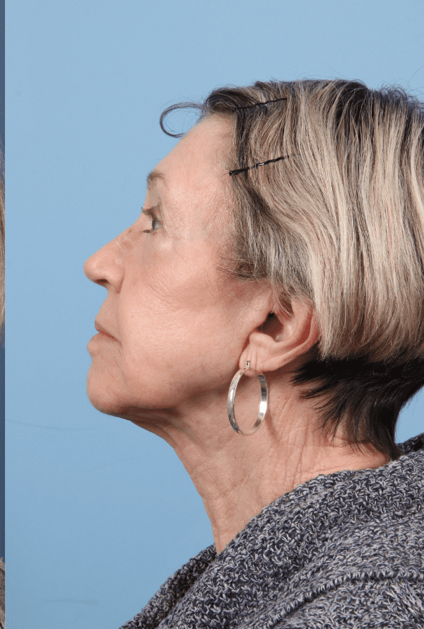 Facelift Patient Photo - Case 15751 - after view-1