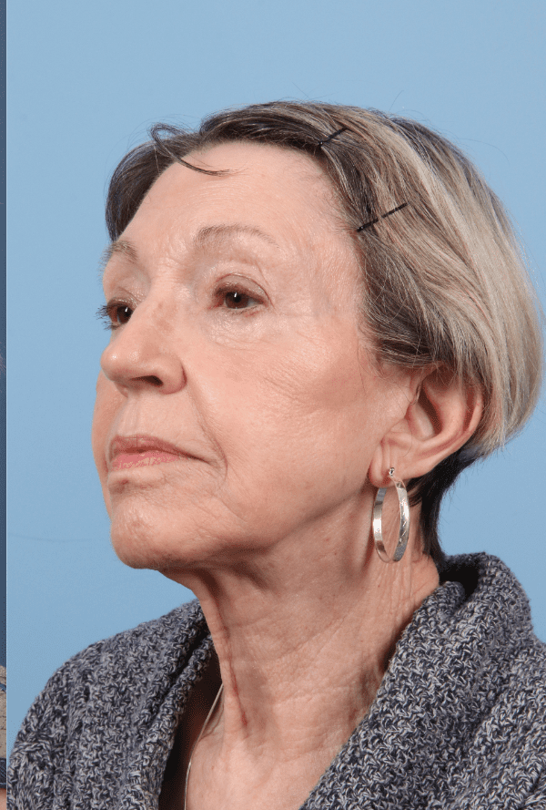 Facelift Patient Photo - Case 15751 - after view-3