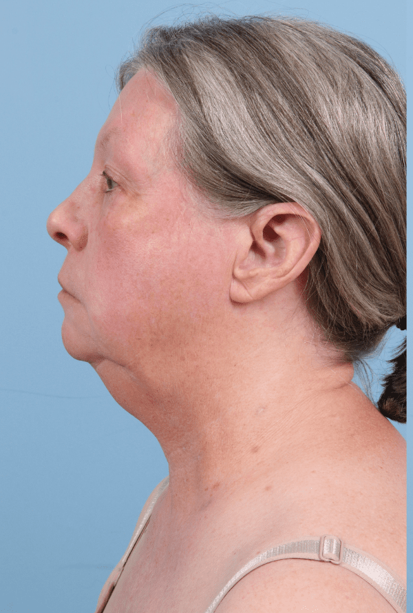 Facelift Patient Photo - Case 15777 - before view-1
