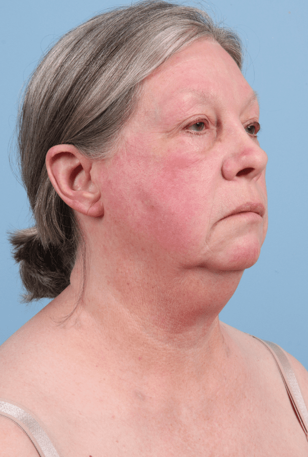 Facelift Patient Photo - Case 15777 - before view-4