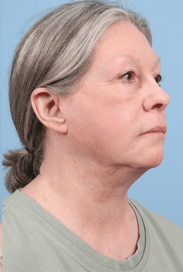 Facelift Patient Photo - Case 15777 - after view-4