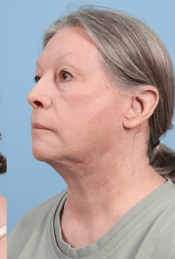 Facelift Patient Photo - Case 15777 - after view-3