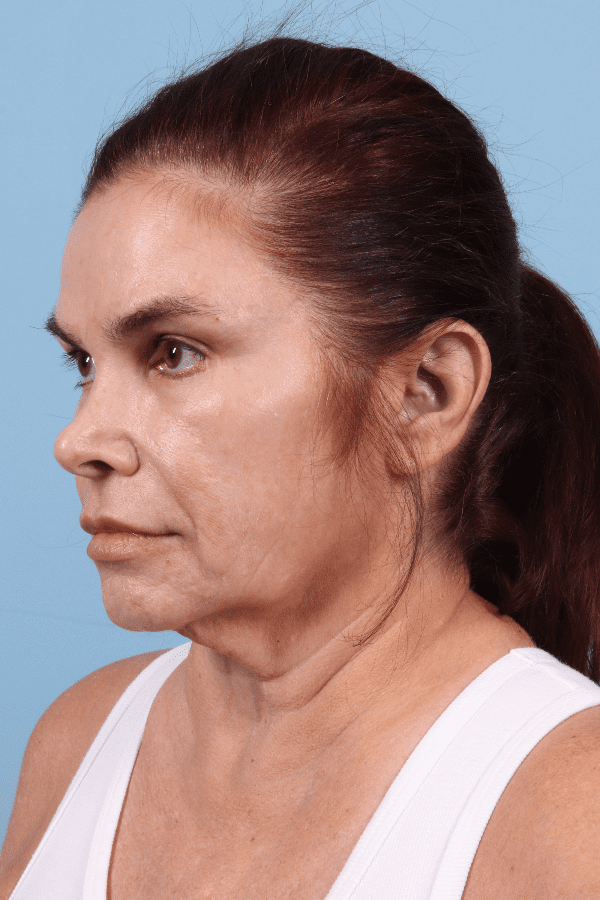 Facelift Patient Photo - Case 15790 - before view-3