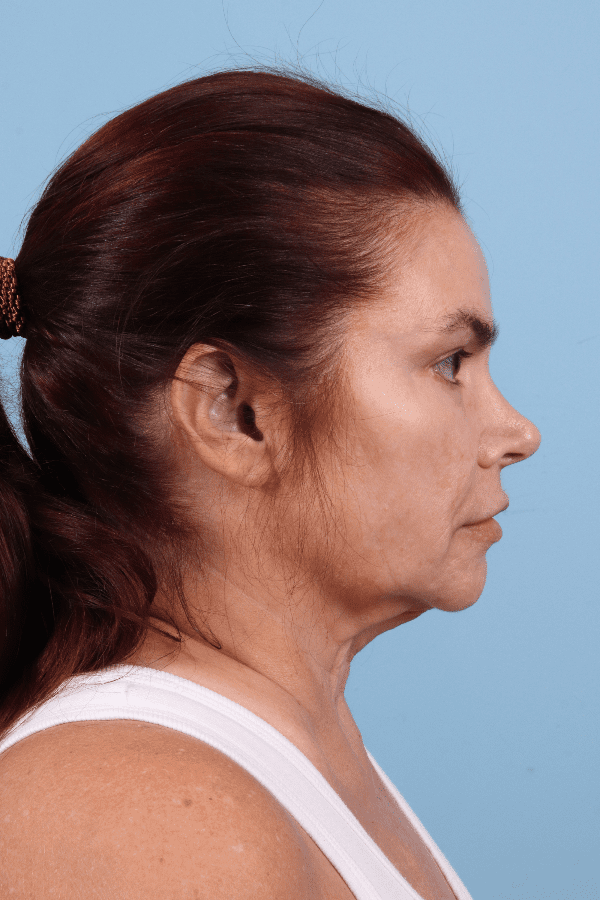 Facelift Patient Photo - Case 15790 - before view-2