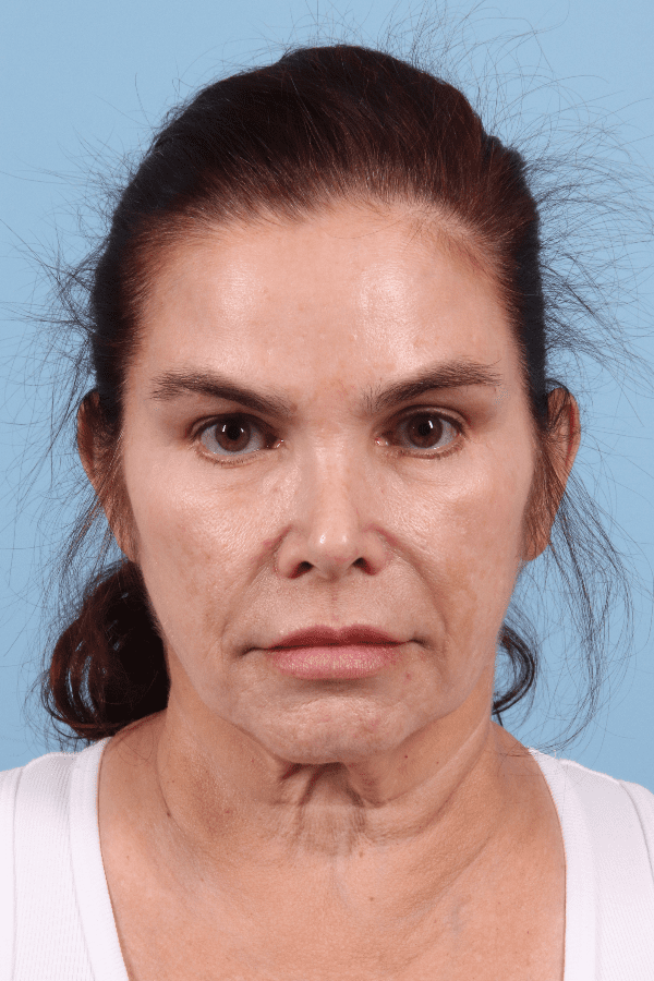 Facelift Patient Photo - Case 15790 - before view-
