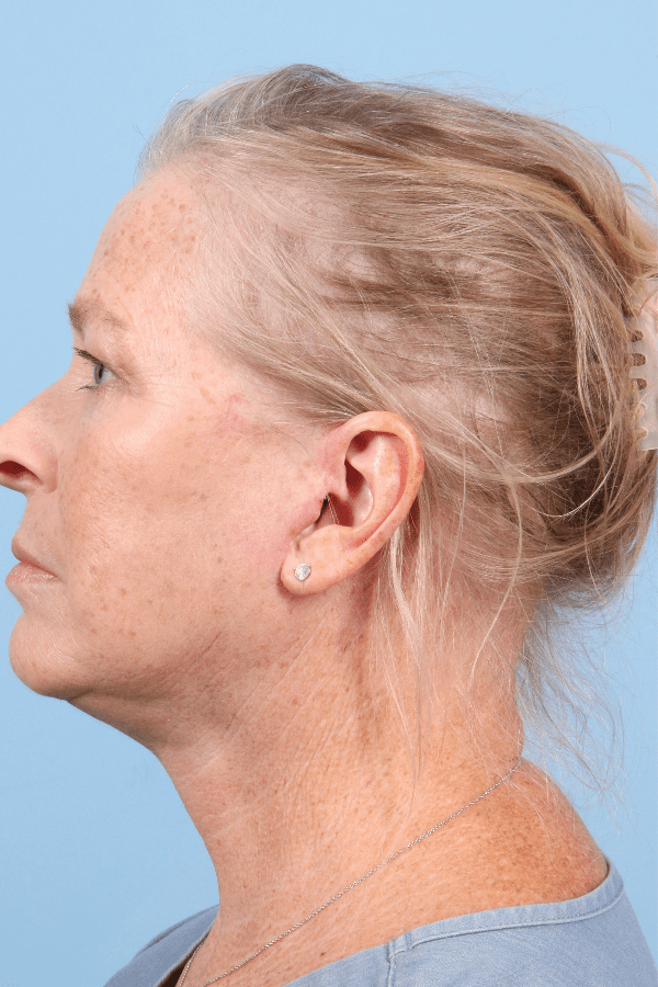 Facelift Patient Photo - Case 15802 - after view-1