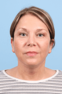 Facelift - Case 15814 - After