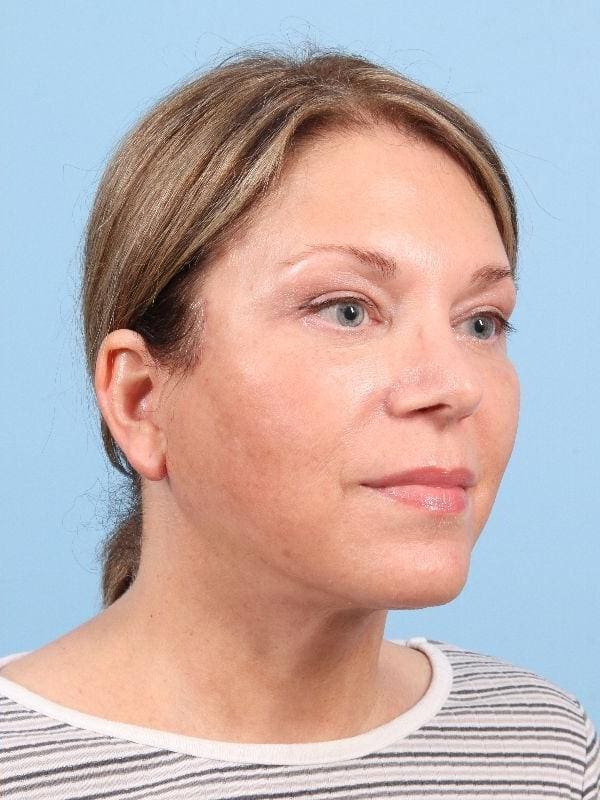 Facelift Patient Photo - Case 15814 - after view-4