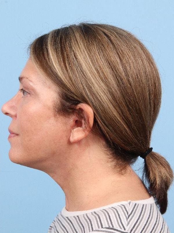 Facelift Patient Photo - Case 15814 - after view-1
