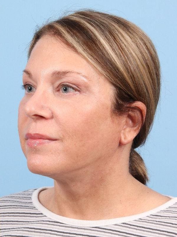 Facelift Patient Photo - Case 15814 - after view-3