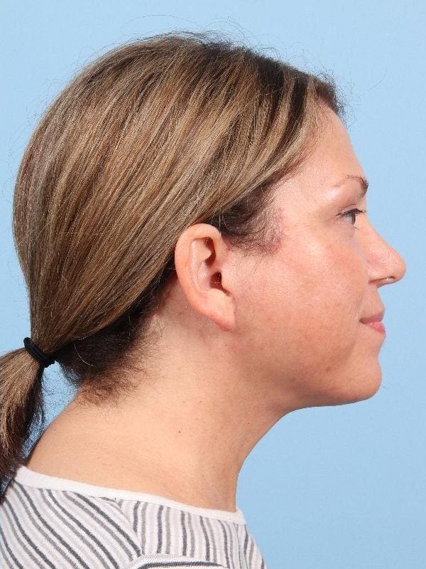 Facelift Patient Photo - Case 15814 - after view-2