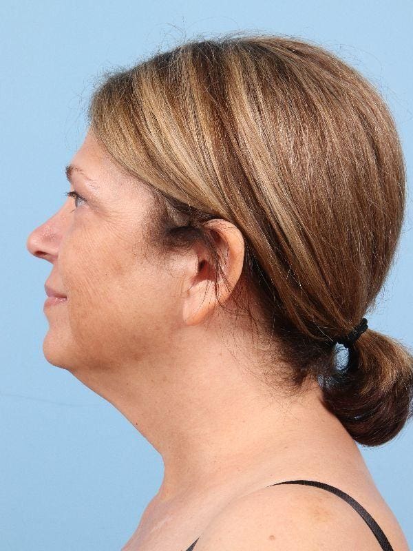 Facelift Patient Photo - Case 15814 - before view-1