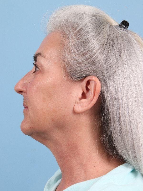 Facelift Patient Photo - Case 15826 - before view-1