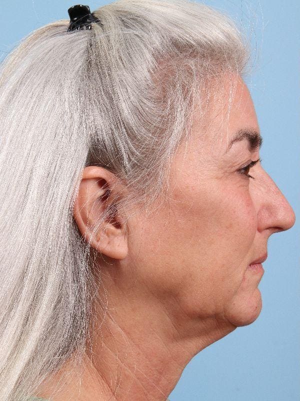Facelift Patient Photo - Case 15826 - before view-2