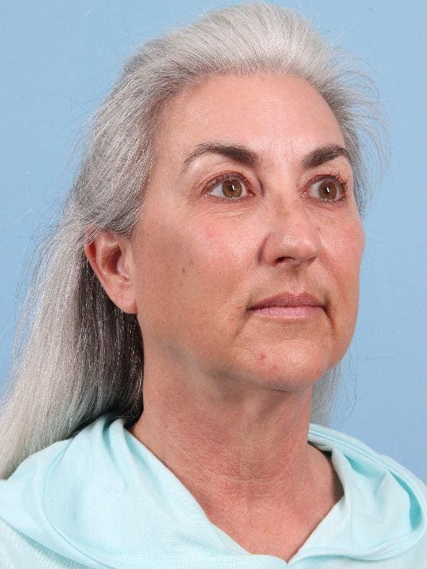Facelift Patient Photo - Case 15826 - before view-4
