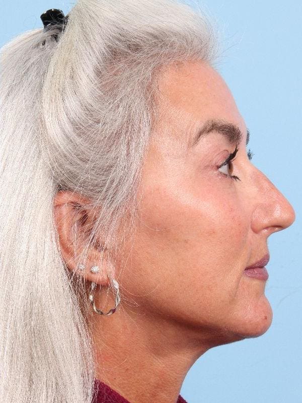 Facelift Patient Photo - Case 15826 - after view-2