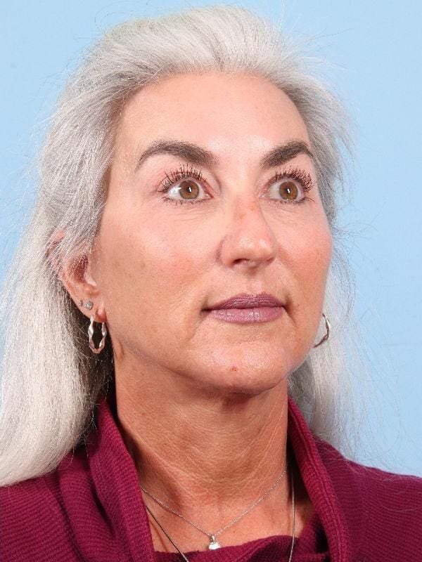Facelift Patient Photo - Case 15826 - after view-4