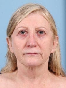 Facelift - Case 15839 - Before