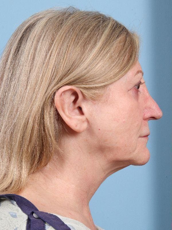 Facelift Patient Photo - Case 15839 - before view-2