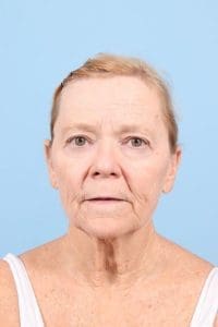 Facelift - Case 15865 - Before