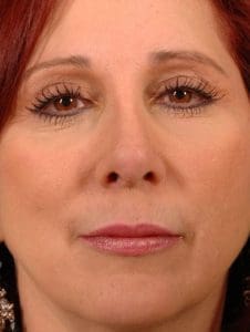 Laser Resurfacing - Case 15877 - After
