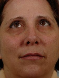 Laser Resurfacing - Case 15877 - Before