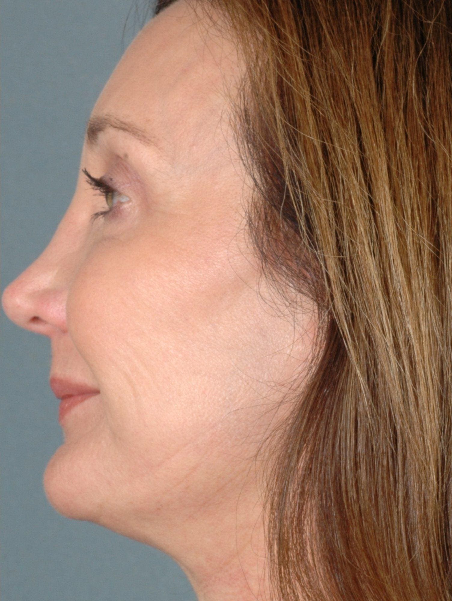 Laser Resurfacing Patient Photo - Case 15883 - after view-1