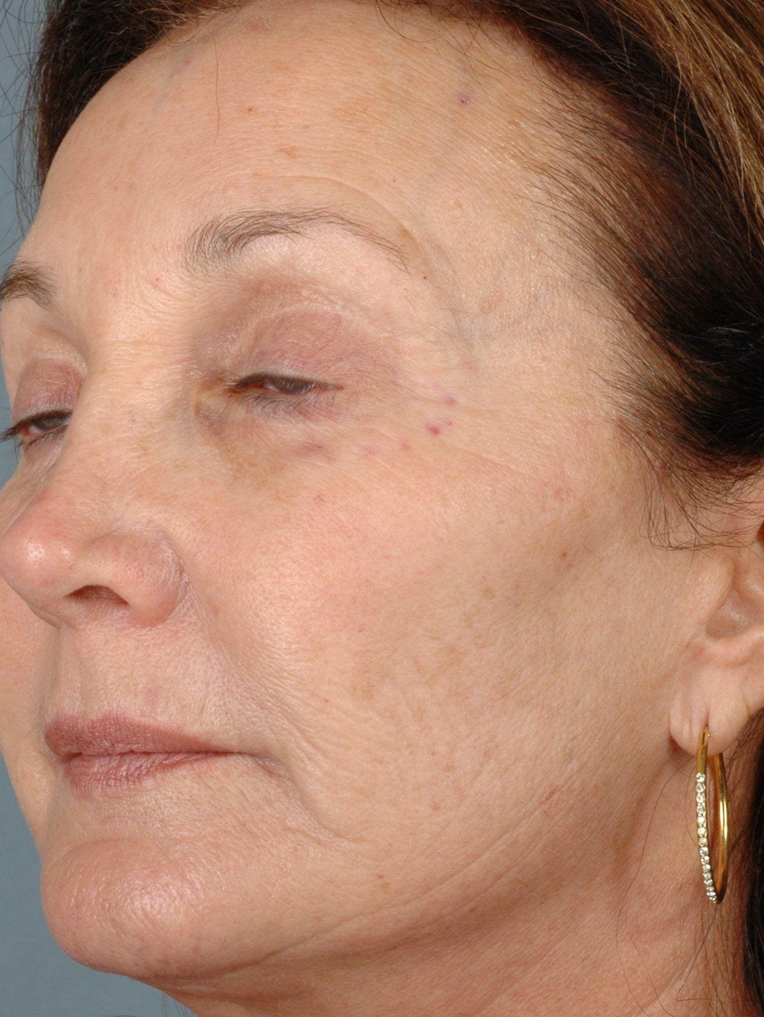 Laser Resurfacing Patient Photo - Case 15883 - before view-2
