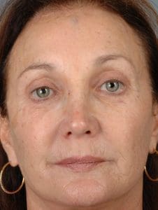 Laser Resurfacing - Case 15883 - Before