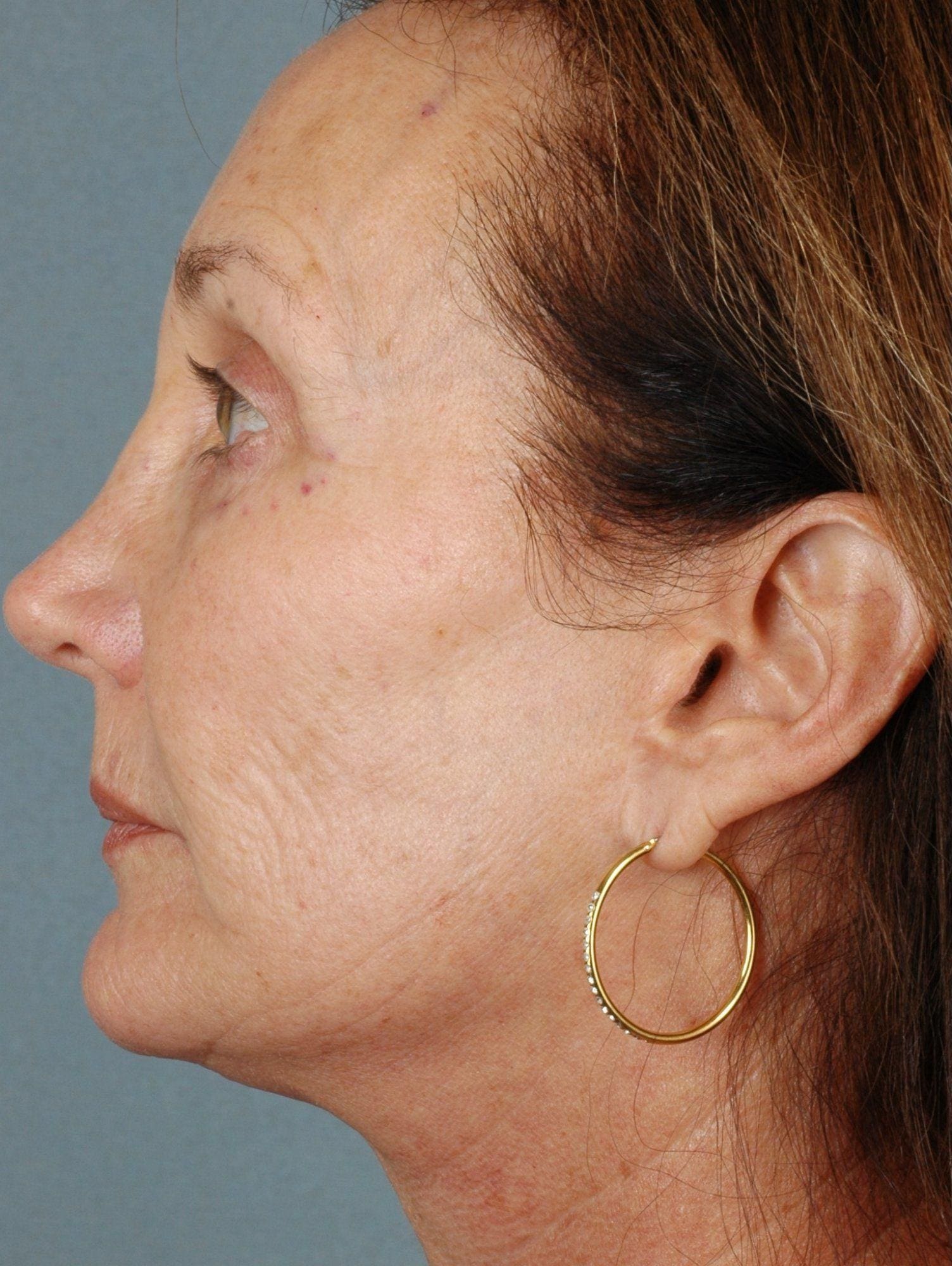 Laser Resurfacing Patient Photo - Case 15883 - before view-1