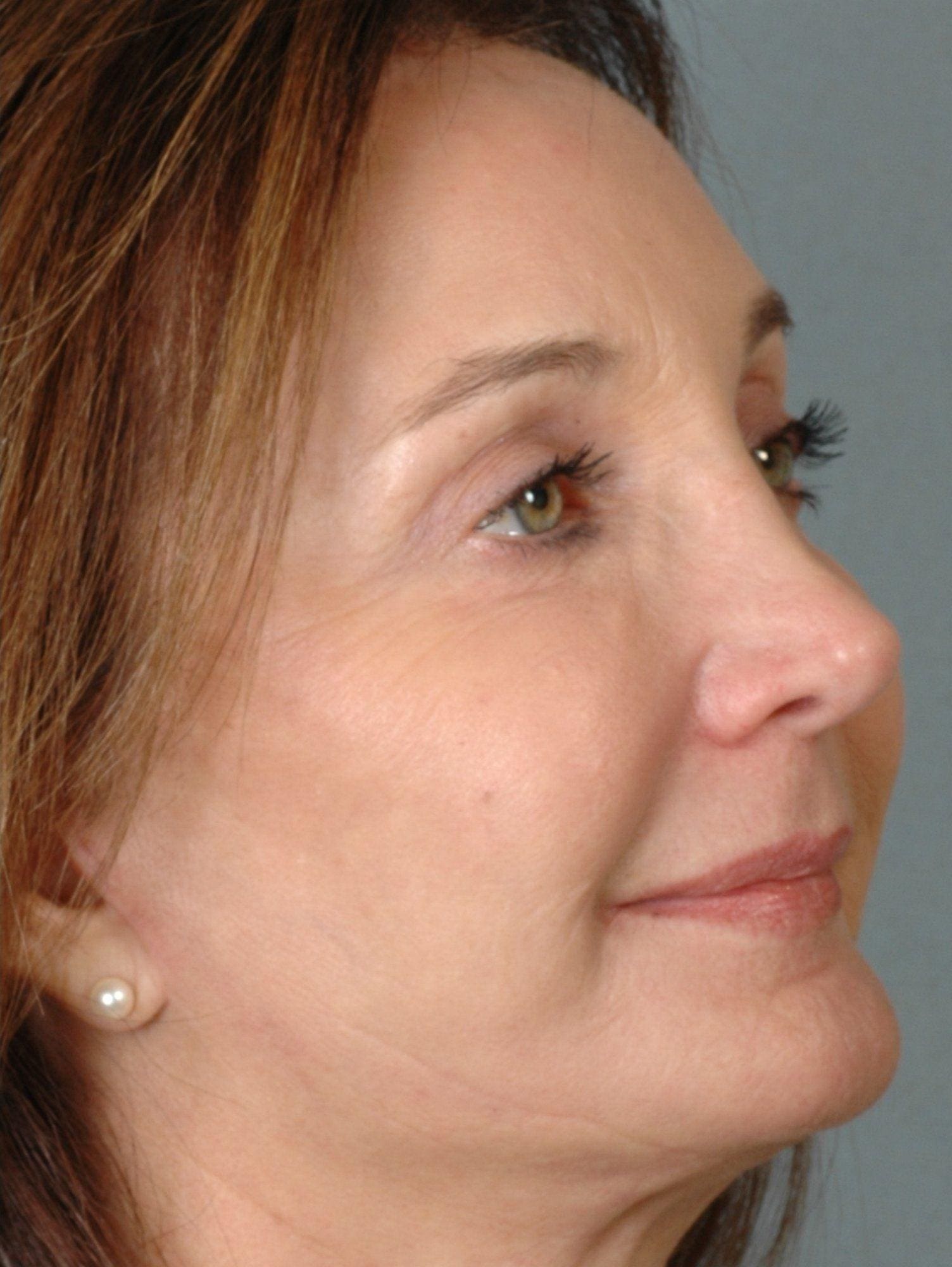 Laser Resurfacing Patient Photo - Case 15883 - after view-3