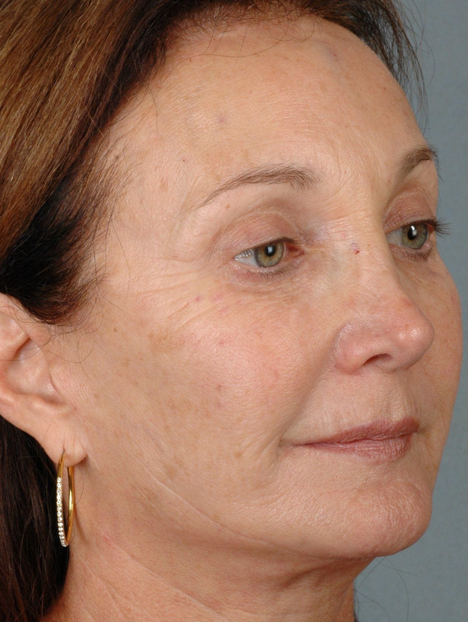 Laser Resurfacing Patient Photo - Case 15883 - before view-3