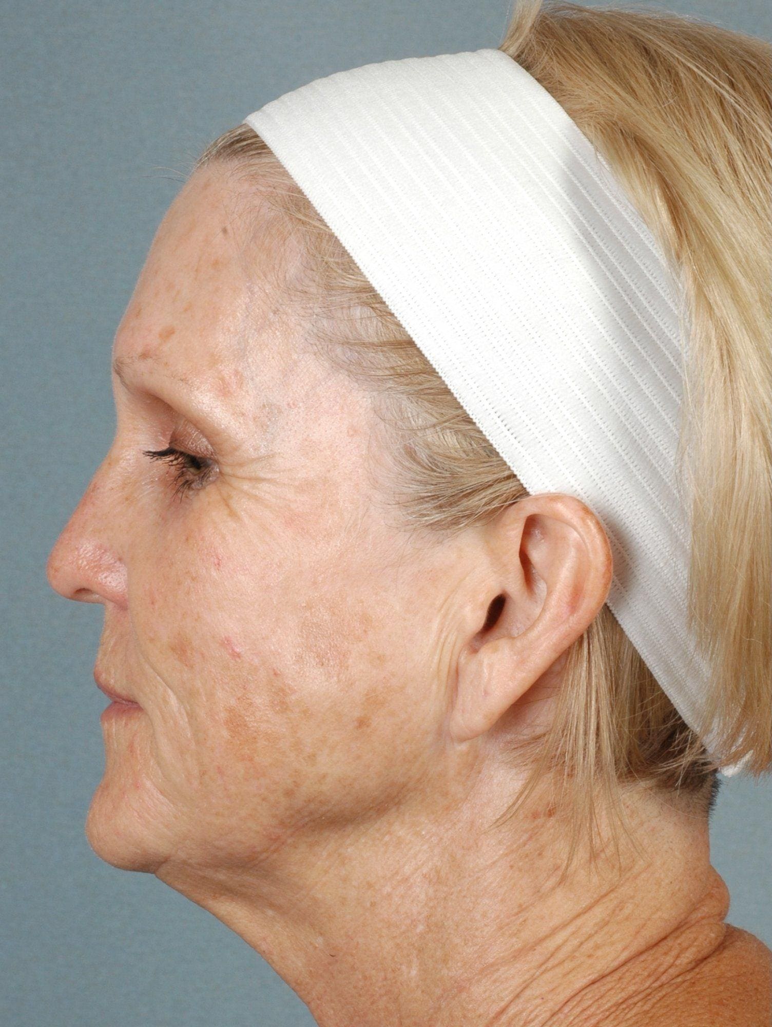 Laser Resurfacing Patient Photo - Case 15893 - before view-2
