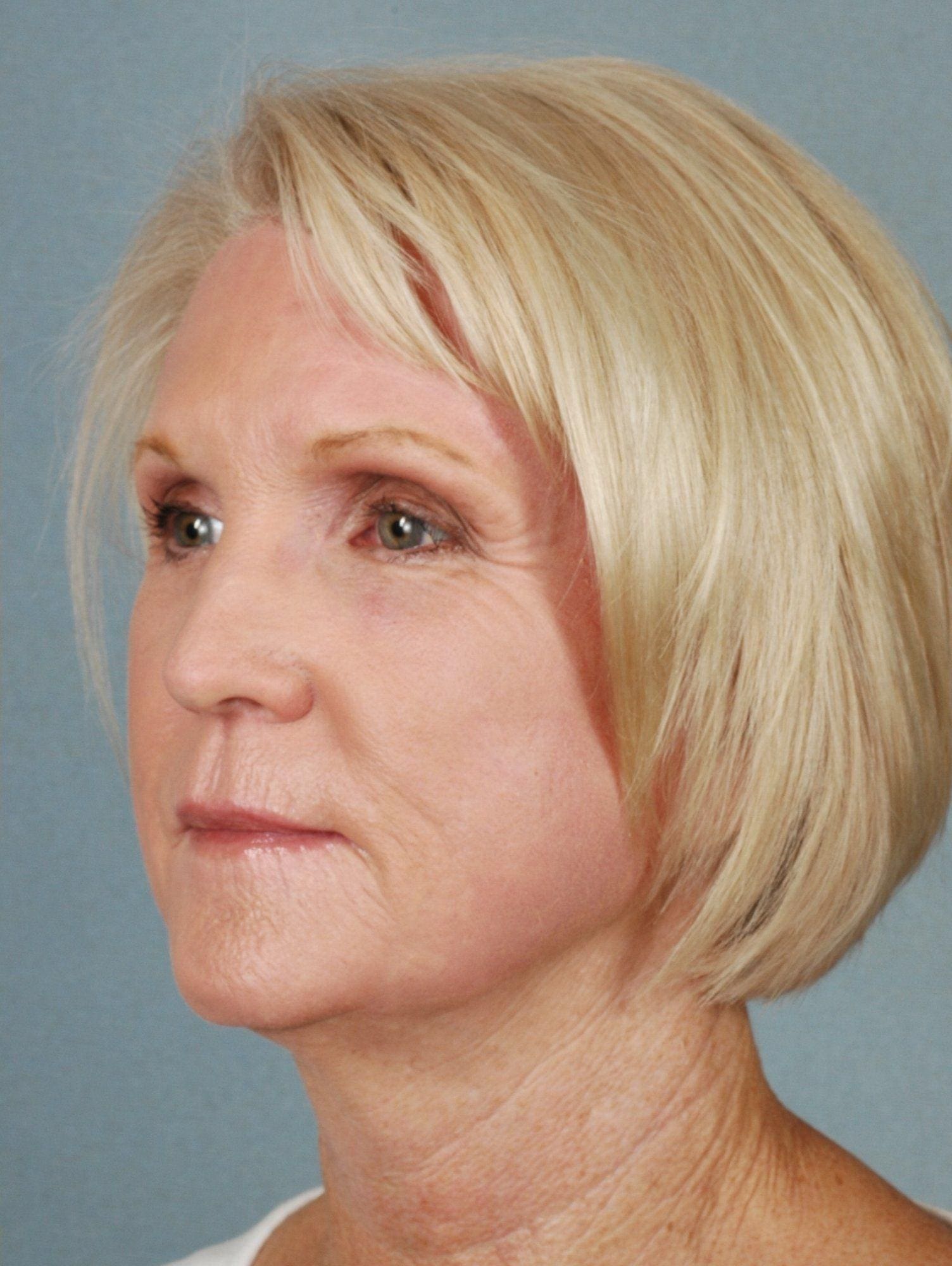 Laser Resurfacing Patient Photo - Case 15893 - after view-4